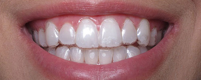 les aligneurs transparents moulés sur la forme de vos dents sont quasiment invisibles